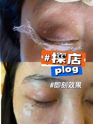 -爱莎扁平疣·汗管瘤·斑痣中心