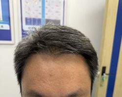 -大麦微针植发全国连锁