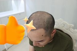 -大麦微针植发丨全国连锁