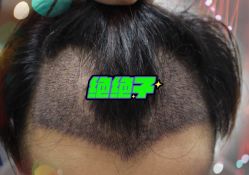 -大麦微针植发全国连锁