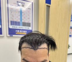 -大麦微针植发全国连锁