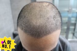 -大麦微针植发丨全国连锁