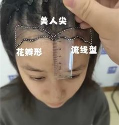 体验前-大麦微针植发丨全国连锁