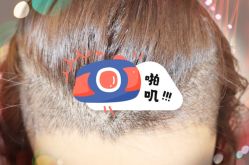 -大麦微针植发全国连锁