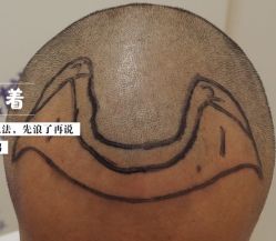 -大麦微针植发全国连锁