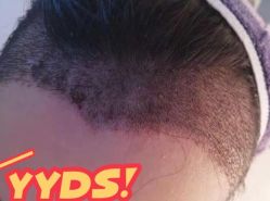 -大麦微针植发丨全国连锁