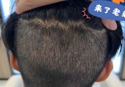 -大麦微针植发全国连锁