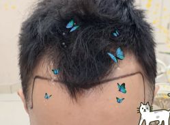 -大麦微针植发全国连锁