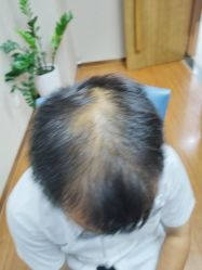 -大麦微针植发全国连锁