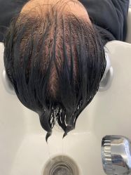 -碧莲盛·脱发养发中心