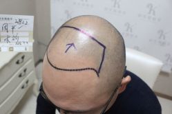 点击看大图 -大麦微针植发丨全国连锁