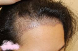 -大麦微针植发丨全国连锁