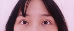 体验前-杭州美莱医疗美容医院