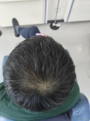 -大麦微针植发全国连锁