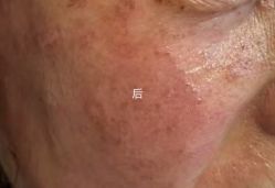 -美丽人生祛斑扁平疣汗管瘤中心