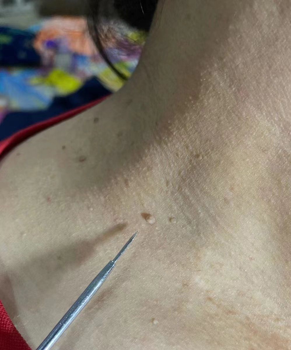 不能放任不管啊,这是低危hpv感染的皮肤