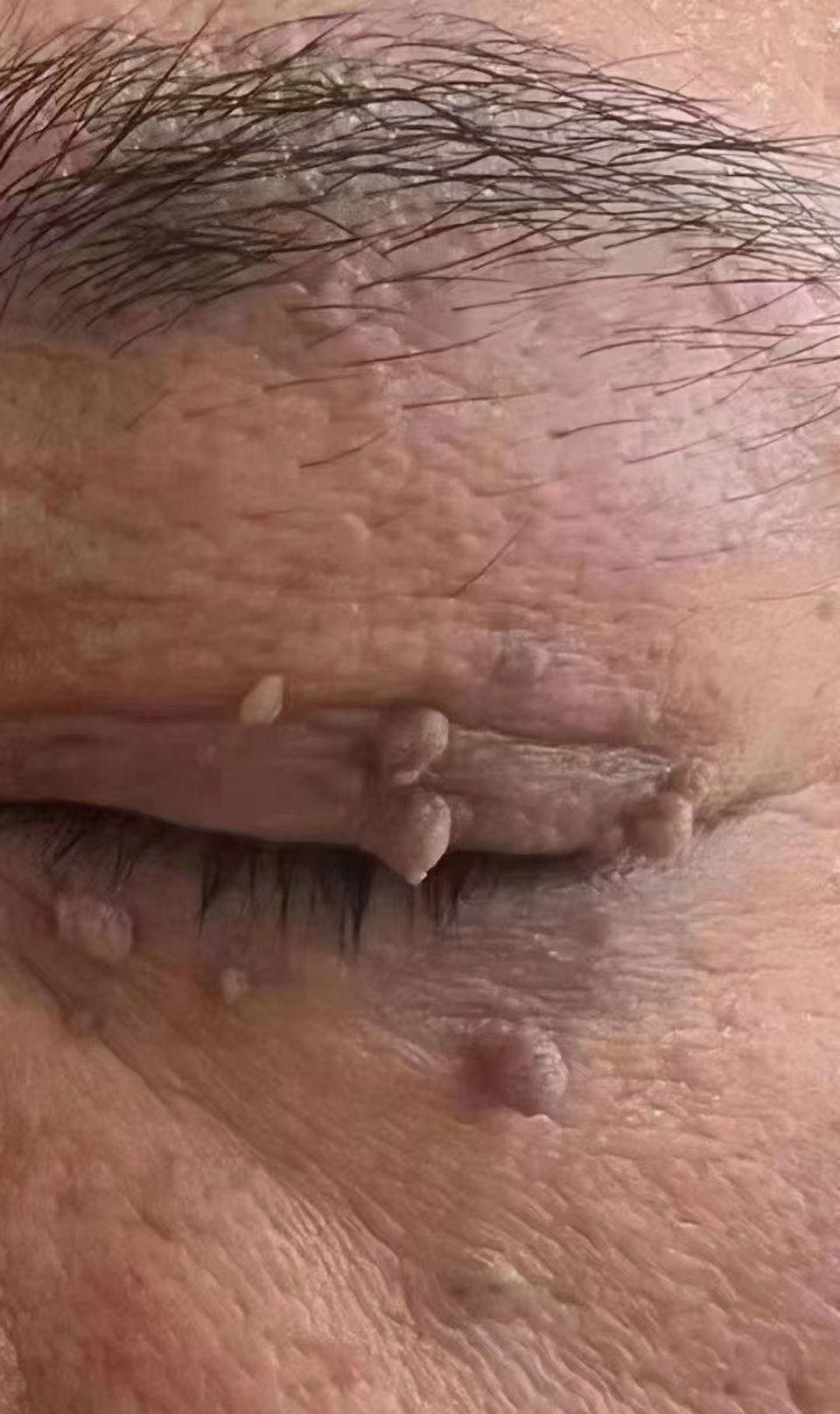 家人们,一定要重视长疣这件事!我这眼皮长