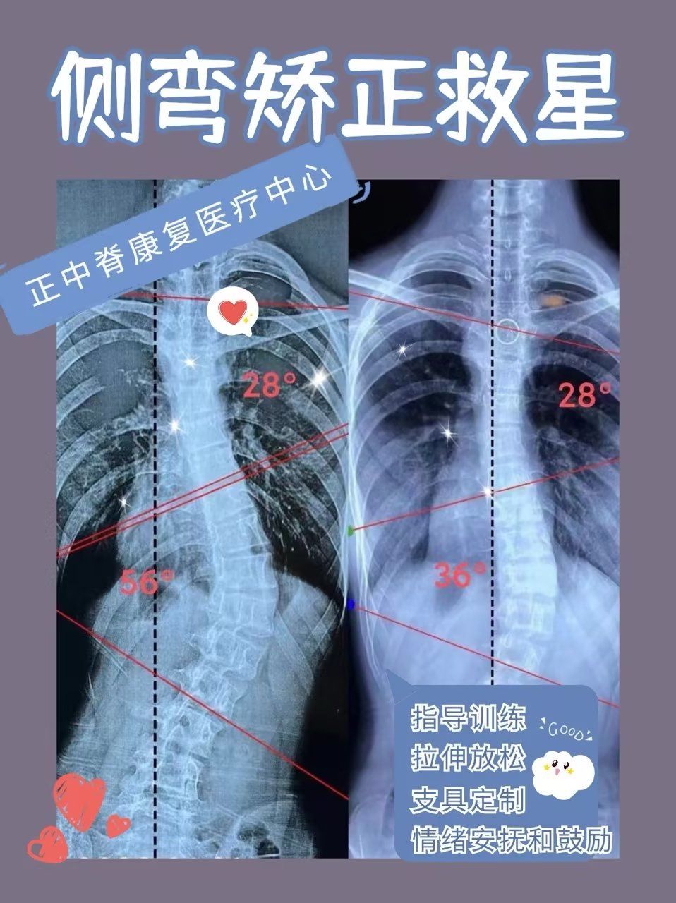 脊柱侧弯矫正救星