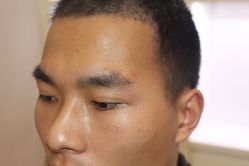 -大麦微针植发丨全国连锁