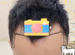 -大麦微针植发全国连锁