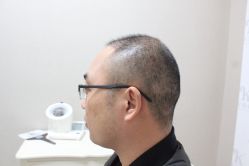 点击看大图 -大麦微针植发丨全国连锁