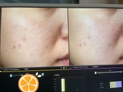 -苑苑vbeauty科技美容SPA