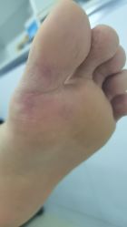 -德哥灰指甲脚气甲沟炎跖疣护理