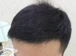 -大麦微针植发丨全国连锁