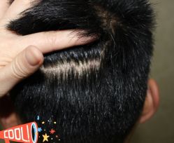 -大麦微针植发丨全国连锁