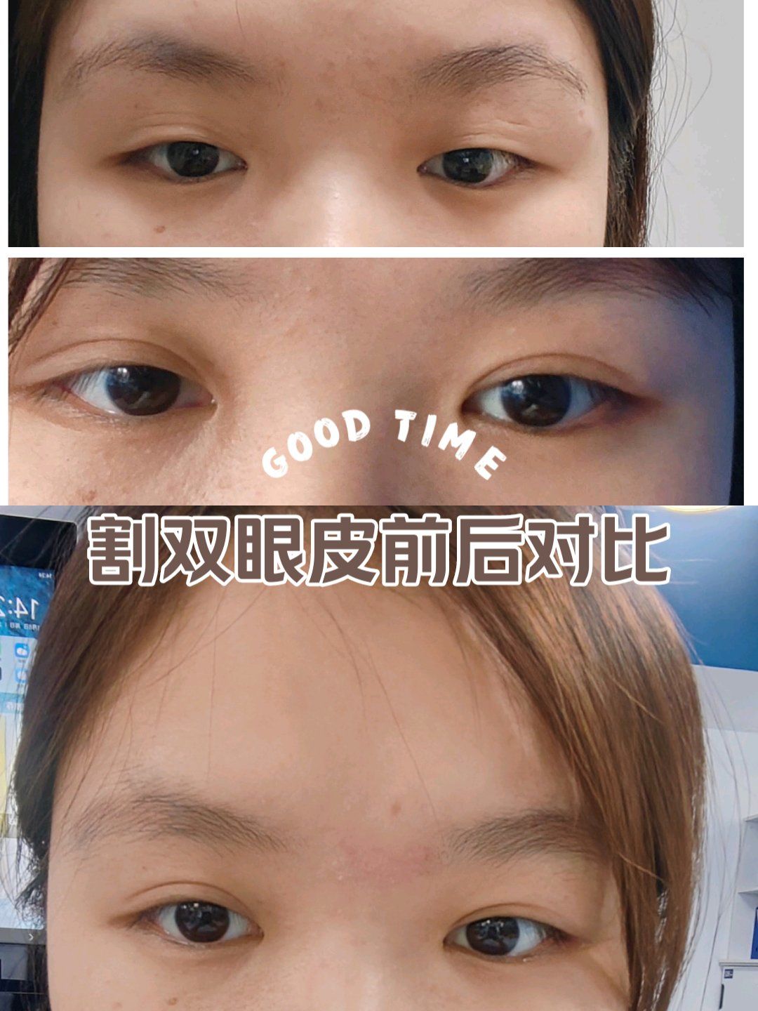 割双眼皮前后对比