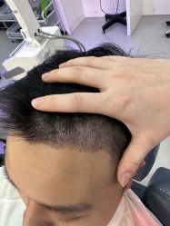 -大麦微针植发全国连锁