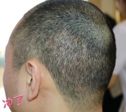 -大麦微针植发丨全国连锁