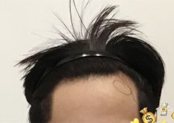 -大麦微针植发全国连锁