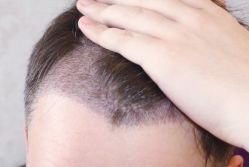 -大麦微针植发全国连锁