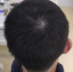 -大麦微针植发丨全国连锁