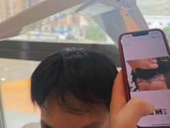 -碧莲盛·不剃发植发