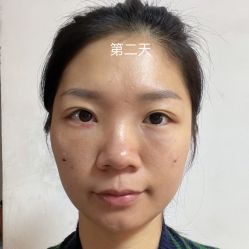 体验后-广州健丽·去眼袋医疗美容机构