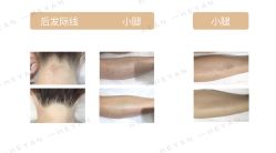 -HEYAN荷妍专业脱毛连锁机构