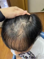 体验前-大麦微针植发全国连锁