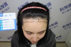 -大麦微针植发丨全国连锁