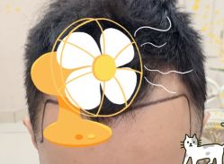 -大麦微针植发全国连锁