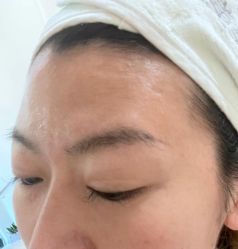 体验后-海涛医疗美容·面部抗衰·注射美鼻