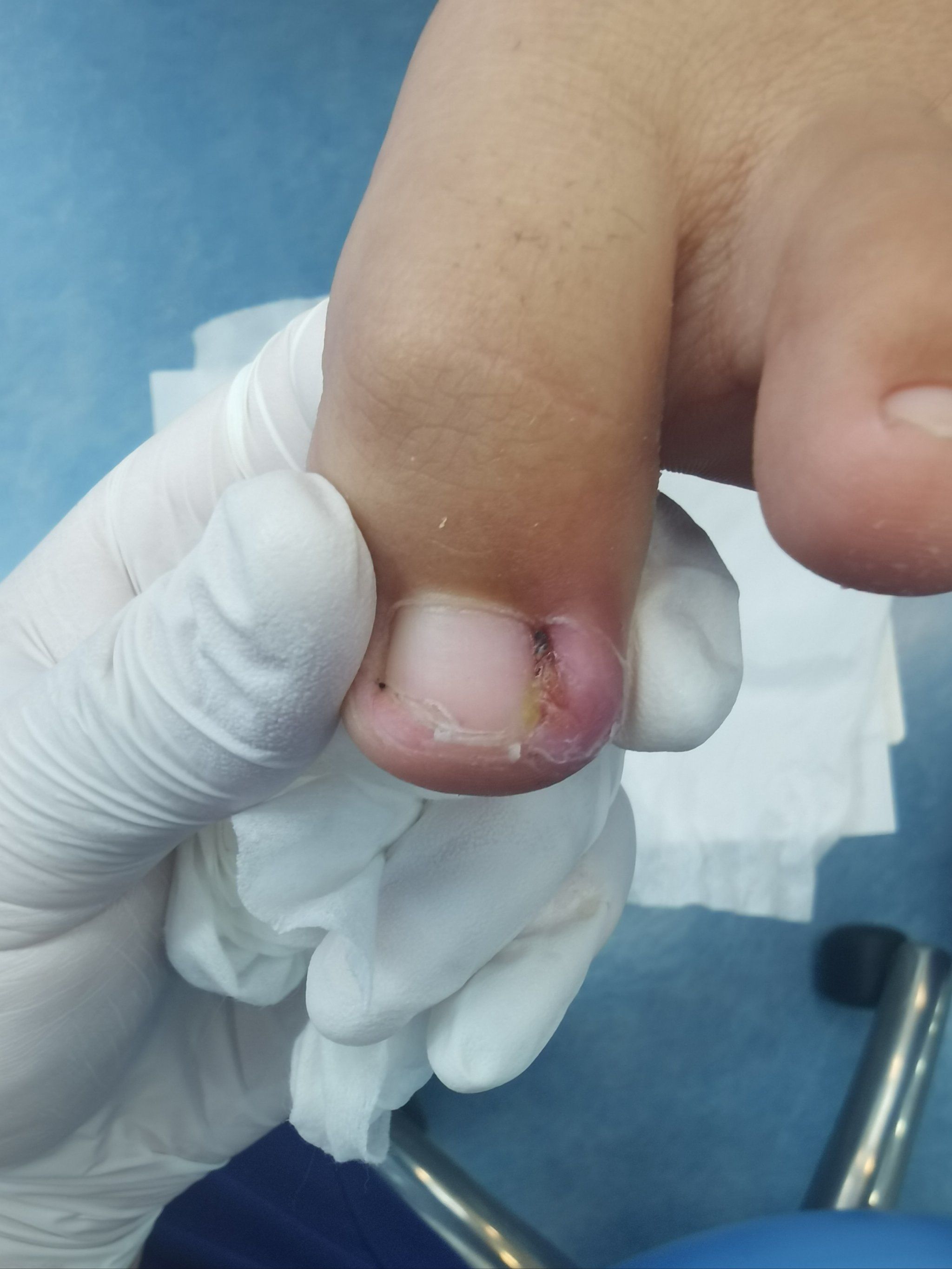 甲沟炎的痛苦曾让我步履维艰,但幸运的是