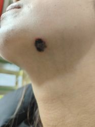 点击看大图 -北京美痣堂古方祛痣斑疣瘊