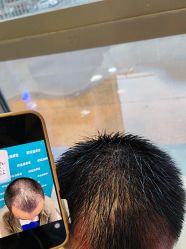 -碧莲盛·不剃发植发