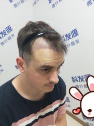 点击看大图 -大麦微针植发丨全国连锁