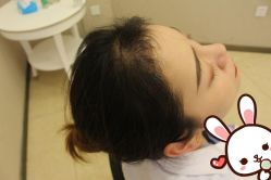 -大麦微针植发丨全国连锁