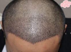 -大麦微针植发丨全国连锁