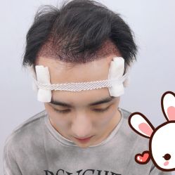 -大麦微针植发丨全国连锁