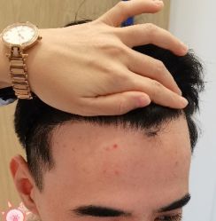 -大麦微针植发丨全国连锁